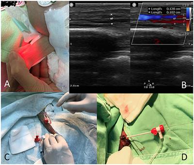 Transcatheter Closure of Patent Ductus Arteriosus in Premature Infants With Very Low Birth Weight